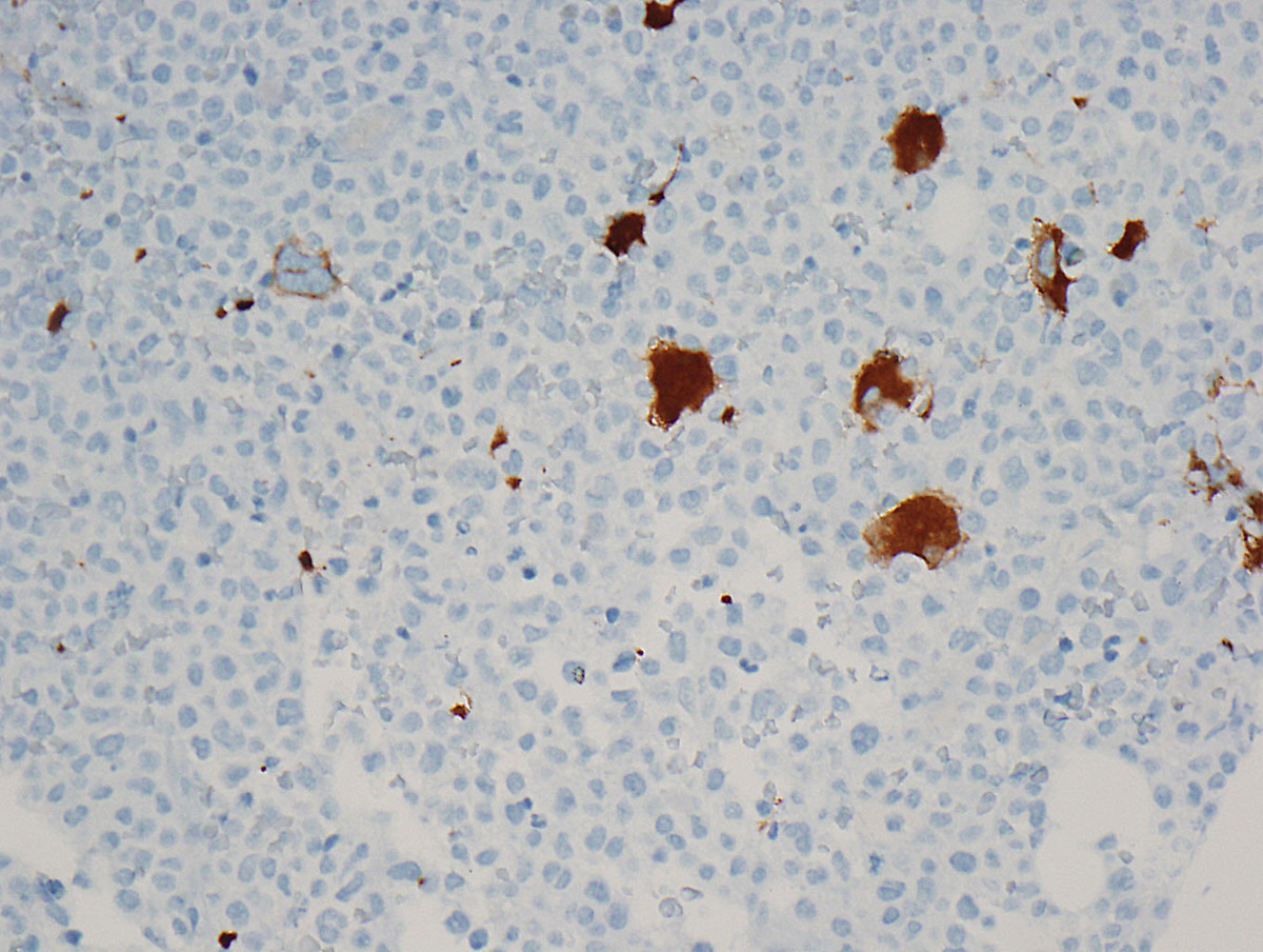 CD61 highlights increased and morphologically variable megakaryocytes.